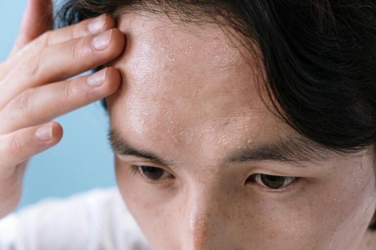 Perimenopause symptoms mistaken for anxiety